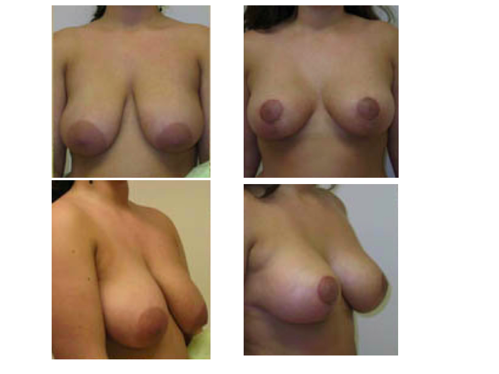 BREAST REDUCTION